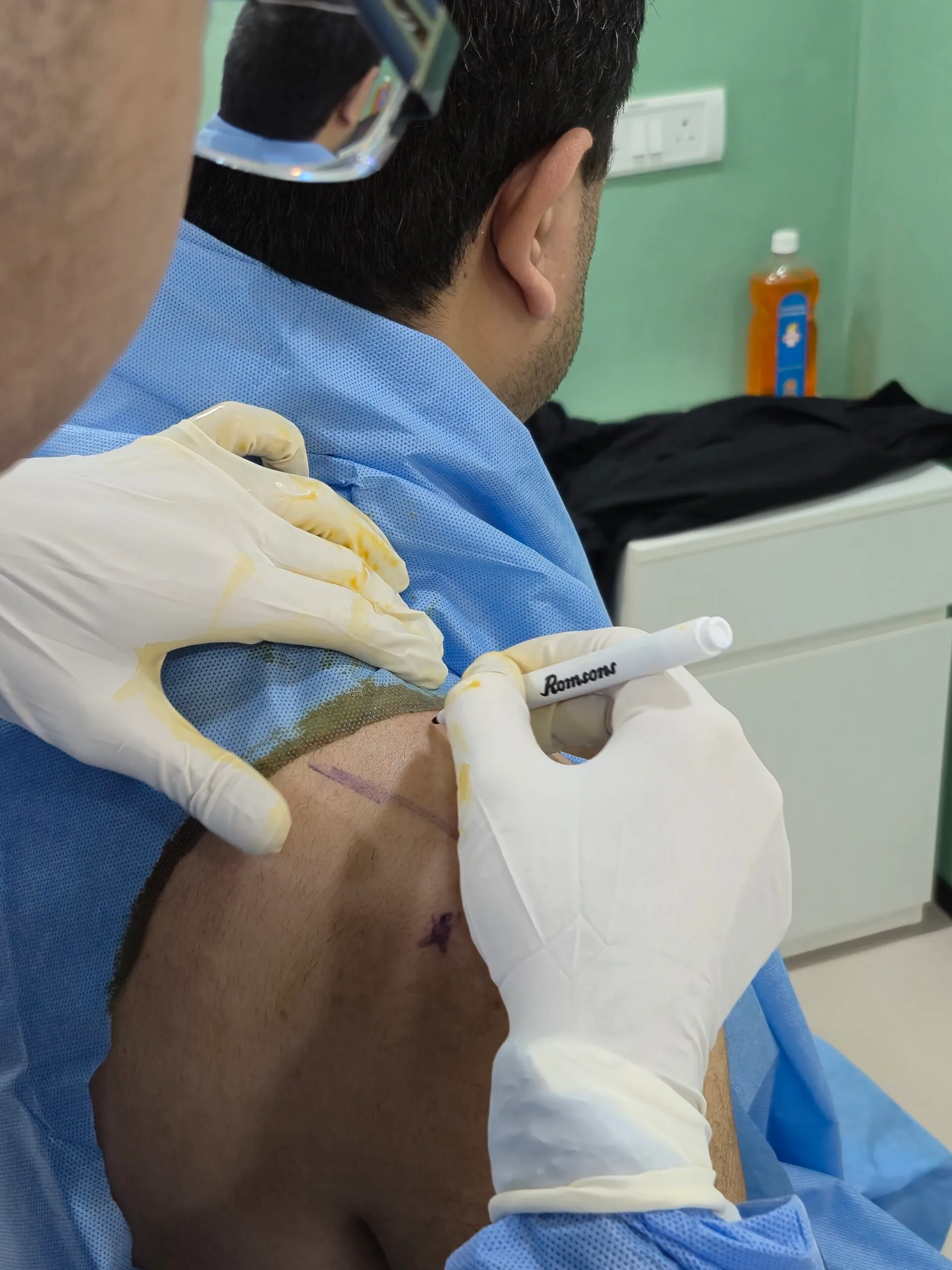 procedure_shoulder_surface marked6
