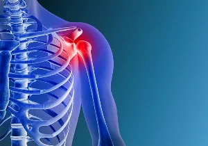 Arthritis.jpg