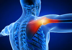 Shoulder Impingement.jpg