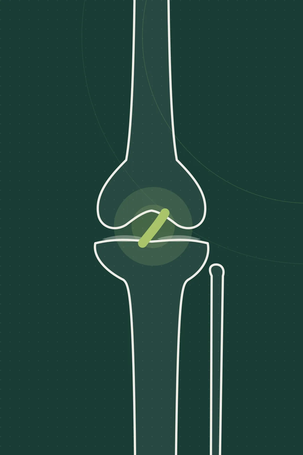 Illustration of the affected joint, not a photograph of the patient