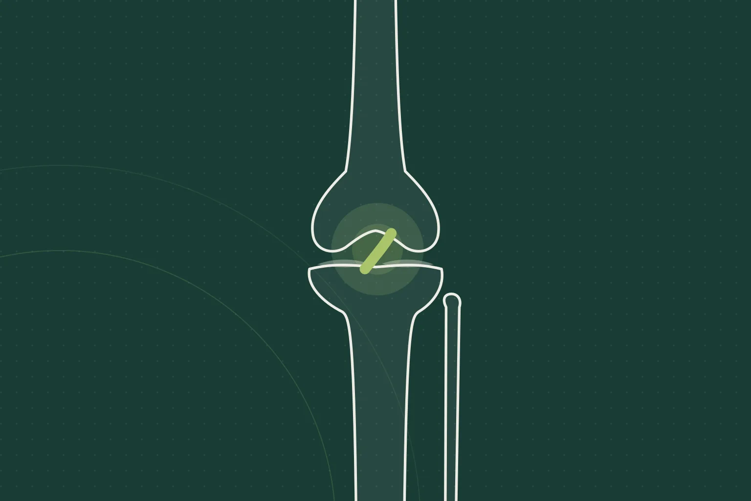Illustration of the affected joint, not a photograph of the patient