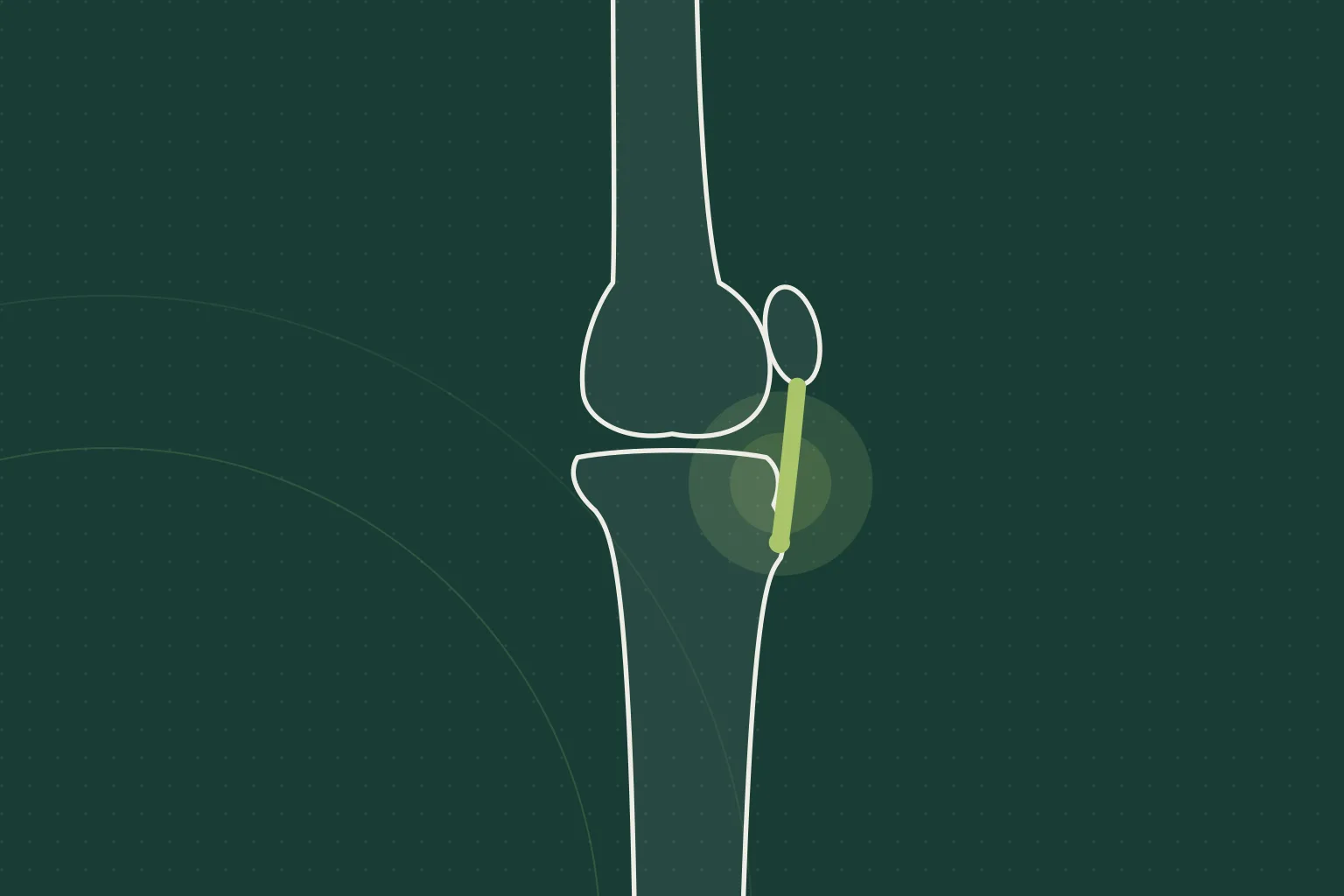 Illustration of the affected joint, not a photograph of the patient