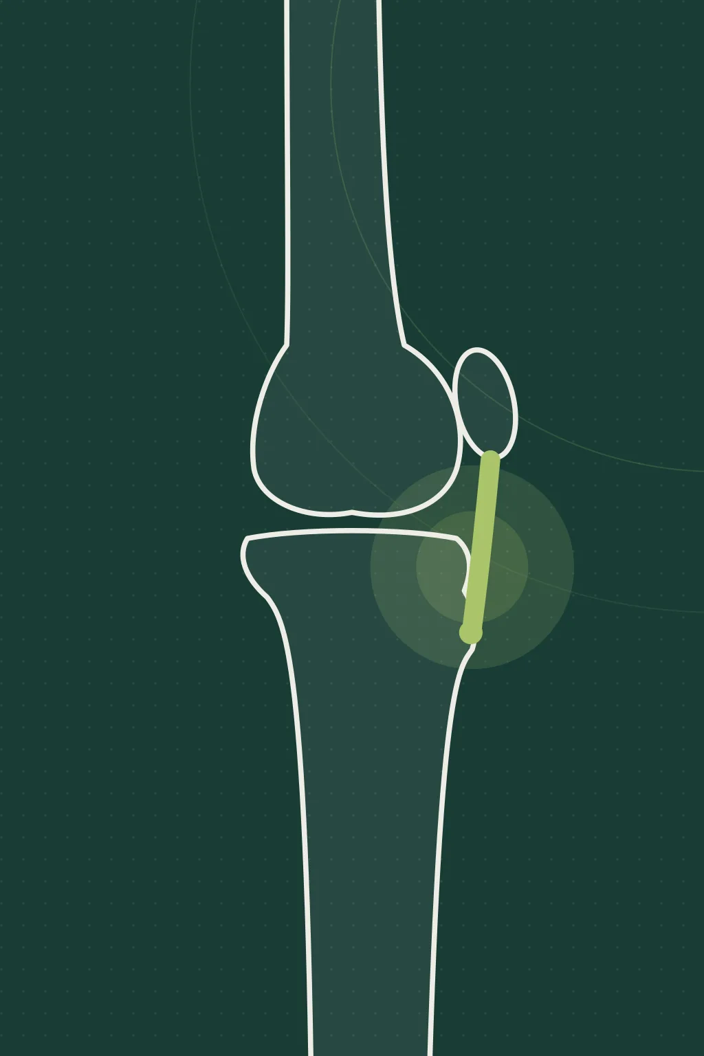 Illustration of the affected joint, not a photograph of the patient
