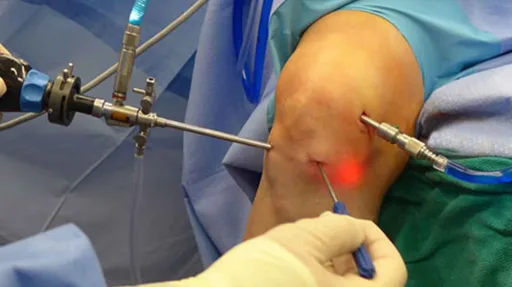 An arthroscopic surgical procedure