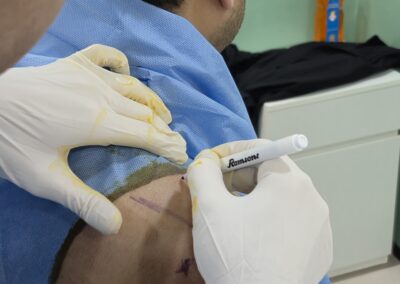 procedure_shoulder_surface marked6